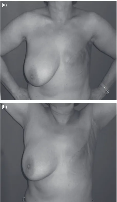 Figure 5. Mastectomy through an ‘‘L’’ incision. (a) All the excesslateral tissue has been excised