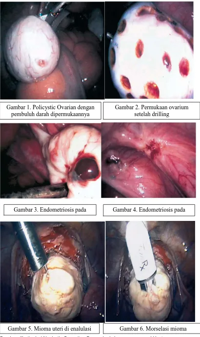 Gambar dikutip dari Nezhat’s Operative Gynecologic Laparoscopy and Hysteroscopy 