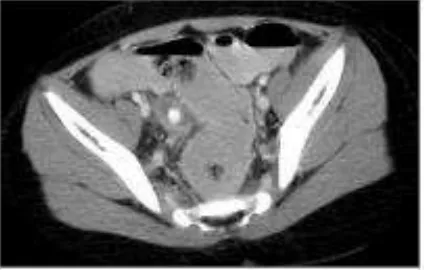 Gambar 2.5. CT scan apendisitis akut pada anak (Minkes, 2013) 