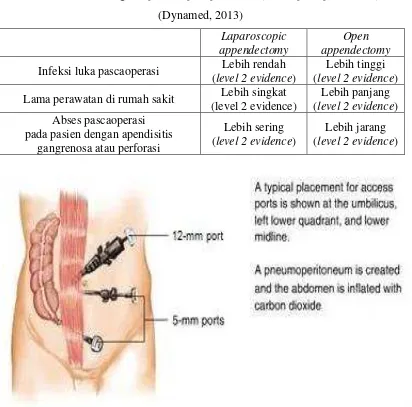 Tabel 2.3. Perbandingan laparoscopic apendectomy dan open apendectomy 