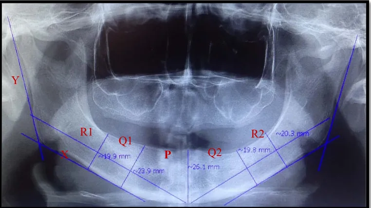 Gambar 7.  Pengukuran ketinggian mandibular alveolar ridge wanita bergigi pada insisivus/midline (P), distal premolar kanan (Q1), distal molar kanan (R1), distal premolar kiri (Q2) dan distal molar kiri (R2), Garis X-garis inferior mandibula, garis Y-garis ramus (arsip pribadi)  