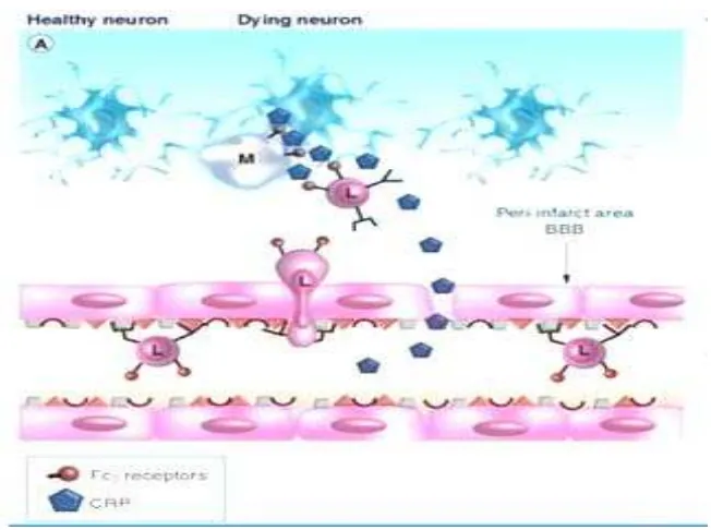 Gambar 3. Mekanisme patogenisitas  C-reactive protein pada susunan saraf pusat  (A) Ikatan yang banyak dari CRP dengan ligan yang terekspos pada sel yang 