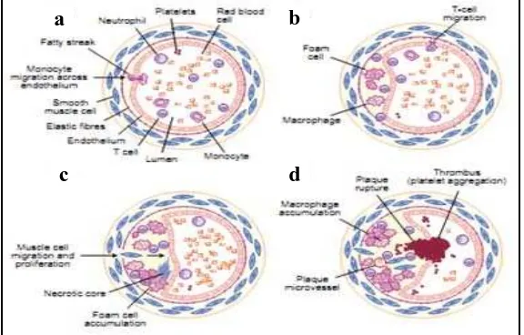 Gambar 2.1  Tahap perkembangan plak aterosklerosis. (a) Fatty streak; (b) Fibrous plaque; (c) Complicated plaque; dan (d) Rupture plaque (WHO, 2011)