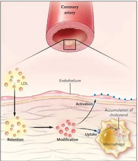 Gambar 2.2. Efek aktivasi infiltrasi LDL pada arteri yang terinflamasi (Hansson, 