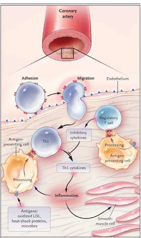 Gambar 2.3. Efek aktivasi sel T pada plak yang terinflamasi (Hansson, 2005). 