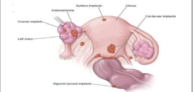 Gambar 3. Lokasi Implantasi Endometriosis 