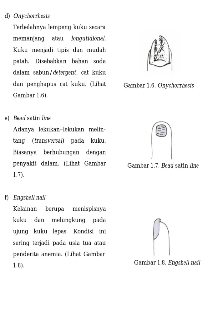Gambar 1.6. Onychorrhesis 