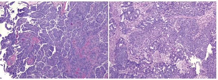 Gambar 2.8. Gambaran mikroskopis high grade serous adenocarcinomapapilla.(B). Tampak sel-sel epitel yang pleomorfik dengan anak inti menonjol.