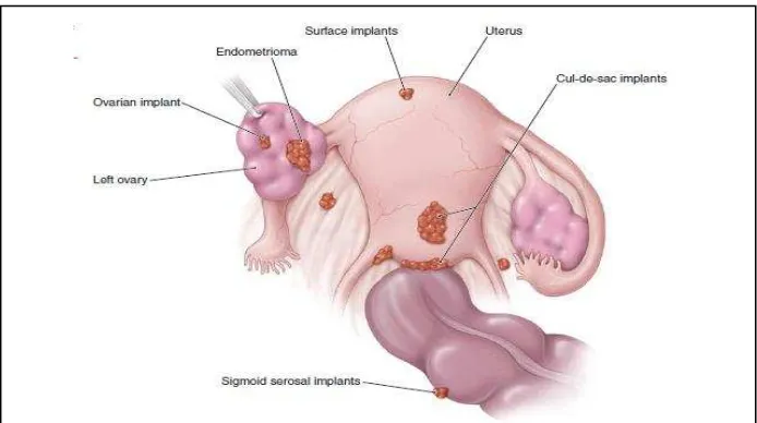 Gambar 3. Lokasi implantasi endometriosis 