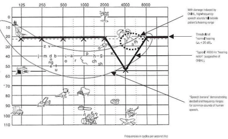 Gambar 2.3 Audiogram standar dengan “menggambarkan pola ciri khas GPAB pada pekerja di frekuensi 4000 Hz speech banana” yang (Kurmis & Apps, 2007)