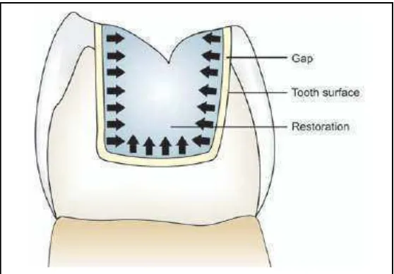 Gambar 2.7  ����������polimerisasi menghasilkan celah di antara bahan restorasi dan permukaan gigi (Garg dan Garg, 2010) 
