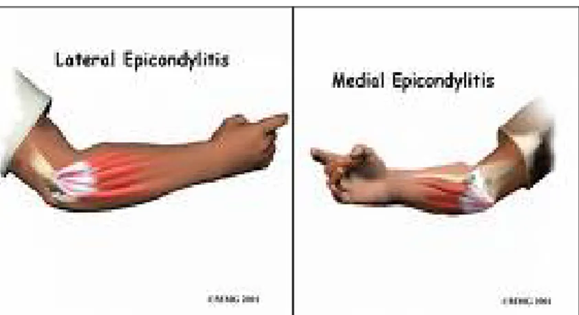 Gambar 8. Tennis Elbow dan Golfer Elbow (Lateral dan Medial Epicondylitis)  