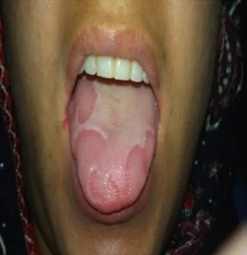 Gambar 3. Angular cheilitis pada sudut mulut dan gambaran geographic tounge (Zaidan, F T.: Angular Cheilitis and Iron Deficiency Anemia