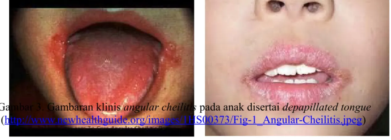 Gambar 3. Gambaran klinis angular cheilitis pada anak disertai depapillated tongue (http://www.newhealthguide.org/images/1HS00373/Fig-1_Angular-Cheilitis.jpeg)  2.6 Pemeriksaan Penunjang 
