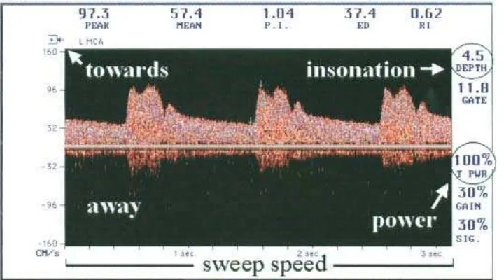 Gambar 3. Tampilan resistance indexpulsed-wave spectral waveform. Identifikasi arah aliran, skala kecepatan (velocity), kedalaman insonasi (depth), kecepatan sweep dan pengaturan power
