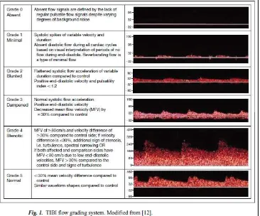 Gambar 4 : TIBI flow grading systemDikutip dari : Mikulik R., Alexandrov A.V.2006. Acute Stroke: Therapeutic Transcranial Doppler Sonography