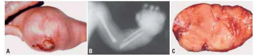 Gambar 2.7.  Fibrosarkoma infantil. A. Fibrosarkoma infantil pada lutut menunjukkan massa yang besar berwarna kebiruan dengan ulserasi pada kulit; B