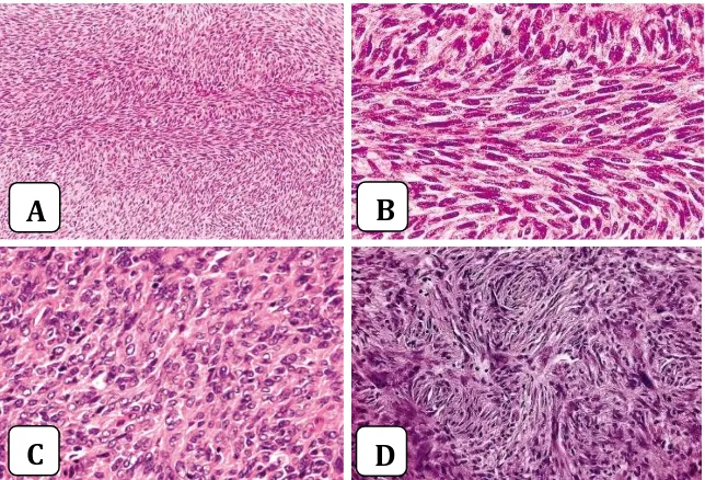 Gambar 2.10. Mikroskopis Fibrosarkoma. A. Fibrosarkoma dengan pola fasikular sel tumor dan pola fasikular yang khas (Pembesaran kuat); C