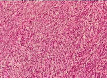 Gambar 2.12. Conventional Fibrosarcoma. Sel-sel spindel yang monoton membentuk pola herringbone.37  