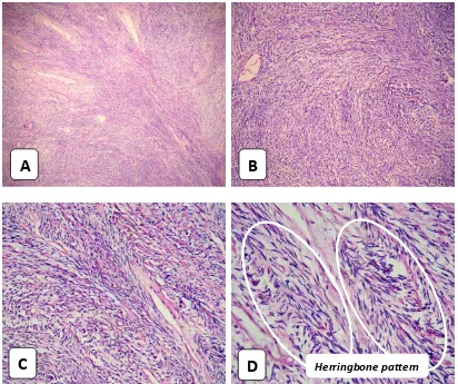 Gambar 2. Gambaran mikroskopis fibrosarkoma ditandai dengan adanya  “herringbone pattern”