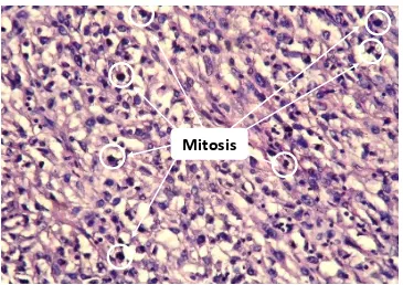 Gambar 4. Gambaran mikroskopis fibrosarkoma dengan area mitosis, HE (400x). 