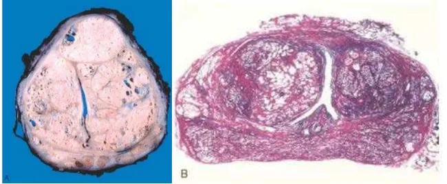 Gambar 2.5. A. Makroskopis hiperplasia prostat jinak; B. Mikroskopis 