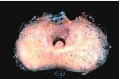 Gambar 2.8. Makroskopis adenokarsinoma prostat.8 