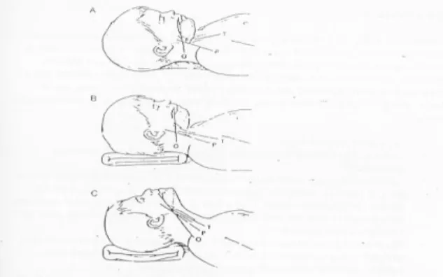 Gambar  6.  A.  Sudut  antara  oral  (O),  faringeal  (P)  dan  trakea  (T)  pada  anak  berusia  2  tahun  bila  anak  terbaring  datar