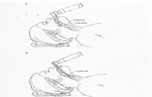 Gambar 3. Teknik penggunaan laringoskop daun lurus dan  lengkung 