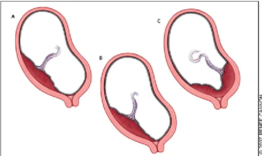 Gambar 1. Types of placenta previa: (A) low lying, (B) marginal,  and (C) complete. Dikutip dari www.aafp.org 