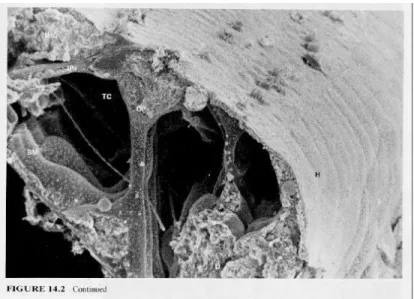 Gambar 13 Scanning elektron mikrograf dari Organ normal dan yang rusak Corti (ref Yost pg  198) 