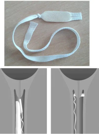 Figure 4. The appearance of Propess® vaginal delivery system (left) and schematic   representation of correct placement (right) (adapted from the references   26 and 27) 