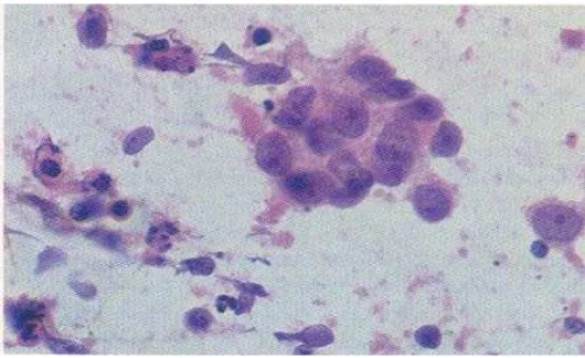 Gambar  4. Kelompokan sel-sel epitel (Dikutip dari: Orell, SR, Philips, J. Fine-Needle Aspiration Cytology, Fourth Edition Elsevier, 2005)