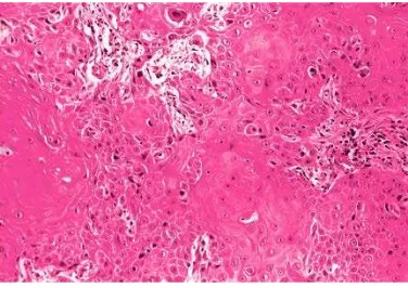 Gambar 5. Mosby, 2004(9)).  Keratinizing Squamous Cell Carcinoma  (Dikutip dari: Rosai J