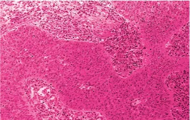 Gambar 6. Non Keratinizing Squamous Cell Carcinoma, differentiated type (Dikutip dari: Rosai J