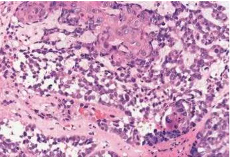 Gambar 10.  Basaloid Squamous Cell Carcinoma pada nasofaring.Sel-sel basaloid menunjukkan festooning growth pattern, sel-sel basaloid berselang-seling dengan 