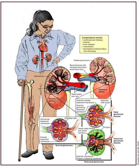 GAMBAR 1.   Perubahan Pathophysiologic pada Penyakit Ginjal Kronis. Penyakit  merupakan  hasil  dari  kerusakan  vaskuler,  glomerulosclerosis  atau  kerusakan  tubulointerstitial
