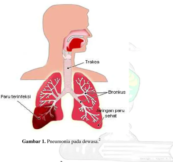 Gambar 1. Pneumonia pada dewasa. 2