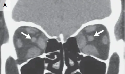 Gambar   9.   Potongan   koronal   pembesaran   otot   rektus   medial   dan   rektus inferior bilateral (diambil dari Grave’s Ophthalmopathy, NEJM)