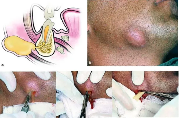 Gambar 1. Abses subkutan yang berasal dari infeksi gigi yang telah menyebar 