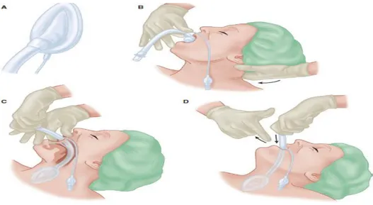 Gambar 3. Pemasangan LMA  Intubasi Endotrakeal 