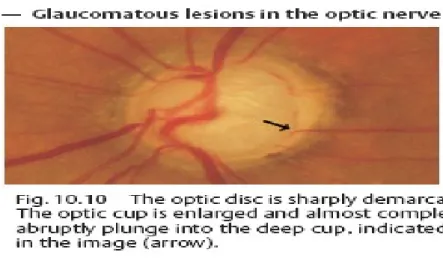 Gambar 2.3 Kelainan Akibat Glaukoma pada Nervus Optikus