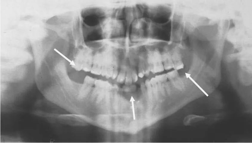 Gambar 8. Menggambarkan molar tiga atas ekstrusi, agenesis pada gigi molar tiga dan keempat                   insisivus mandibula.3  