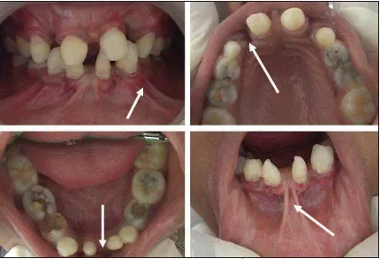 Gambar 14. Pada gambar terlihat typical intra-oral pada pasien EVC.6  