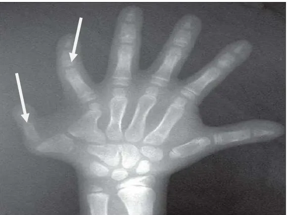 Gambaran radiografi pada pergelangan tangan menunjukkan pemendekan 