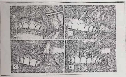 Gambar 1. Reseksi akar  
