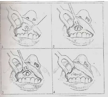 Gambar 3 Reseksi Akar  