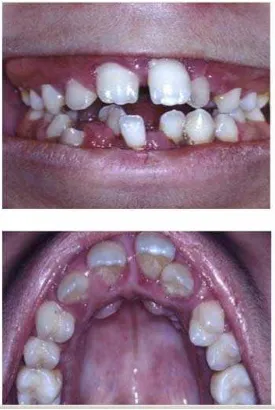 Gambar 8.  Open bite anterior, gigi crowded, gingival enlargement (a),      prominent rugae (b)6 