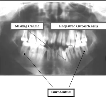 Gambar 13.  Gambaran panoramik menunjukan adanya gigi  impacted 3 