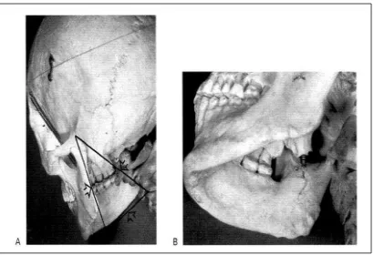 Gambar 3. A. Pandangan melalui radiographic keyhole (tanda panah) menunjukkan gigi posterior kanan mandibula dan maksila.14 